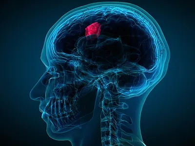 Brain Tumor Treatment In UAE